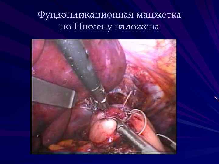 Фундопликационная манжетка по Ниссену наложена 