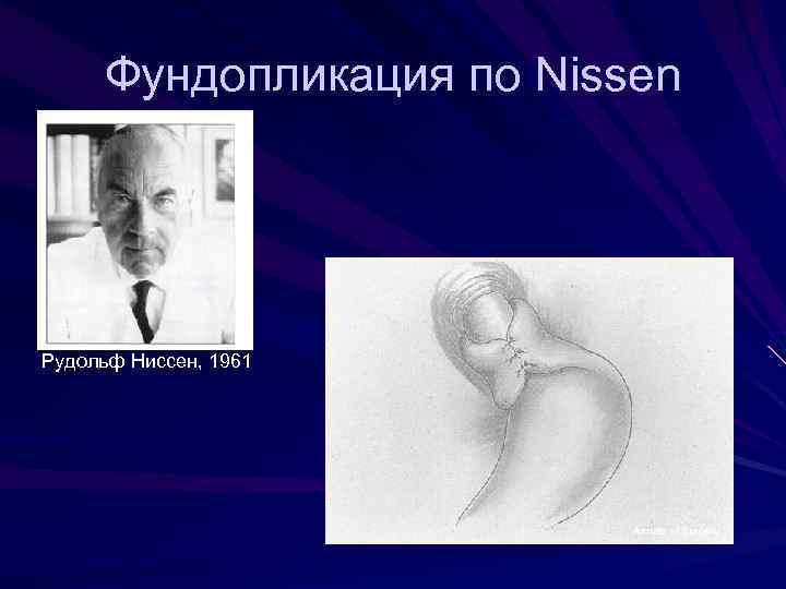Фундопликация по Nissen Рудольф Ниссен, 1961 Annals of Surgery 