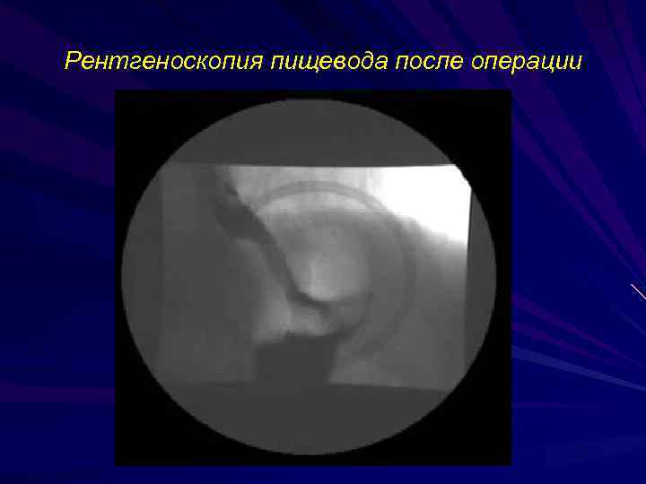 Рентгеноскопия пищевода после операции 