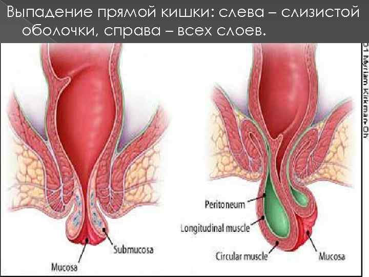 Выпадение прямой кишки: слева – слизистой оболочки, справа – всех слоев. 