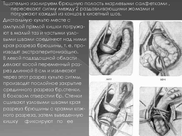 Тщательно изолируем брюшную полость марлевыми салфетками , пересекают сигму между 2 раздавливающими жомами и