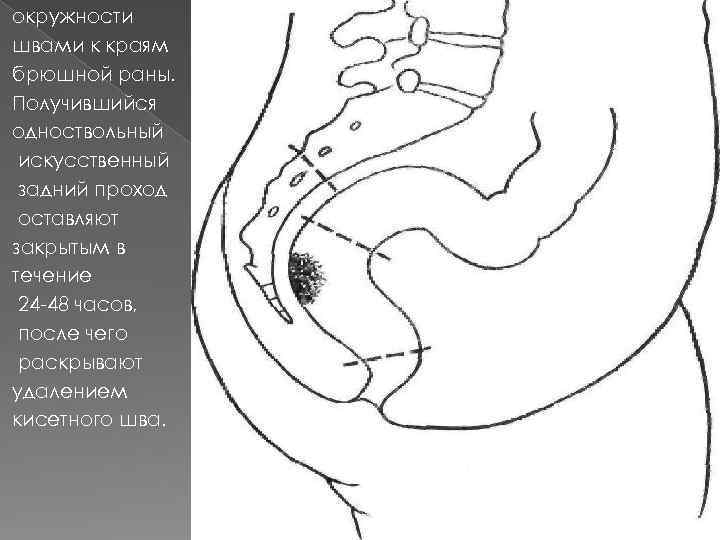 окружности швами к краям брюшной раны. Получившийся одноствольный искусственный задний проход оставляют закрытым в