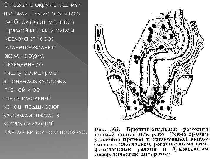 От связи с окружающими тканями. После этого всю мобилизованную часть прямой кишки и сигмы