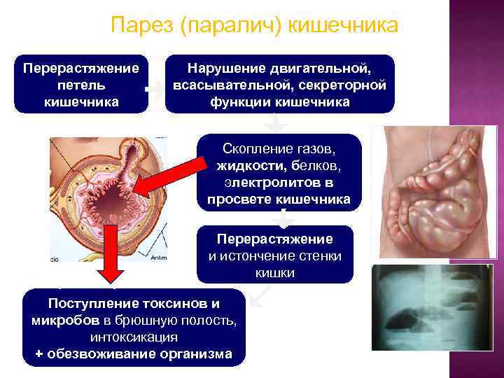 Парез (паралич) кишечника Перерастяжение петель кишечника Нарушение двигательной, всасывательной, секреторной функции кишечника Скопление газов,