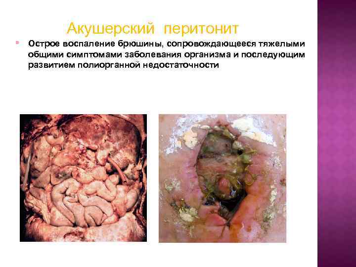 Акушерский перитонит § Острое воспаление брюшины, сопровождающееся тяжелыми общими симптомами заболевания организма и последующим