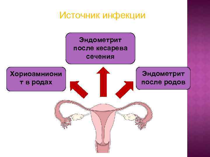 Источник инфекции Эндометрит после кесарева сечения Хориоамниони т в родах Эндометрит после родов 