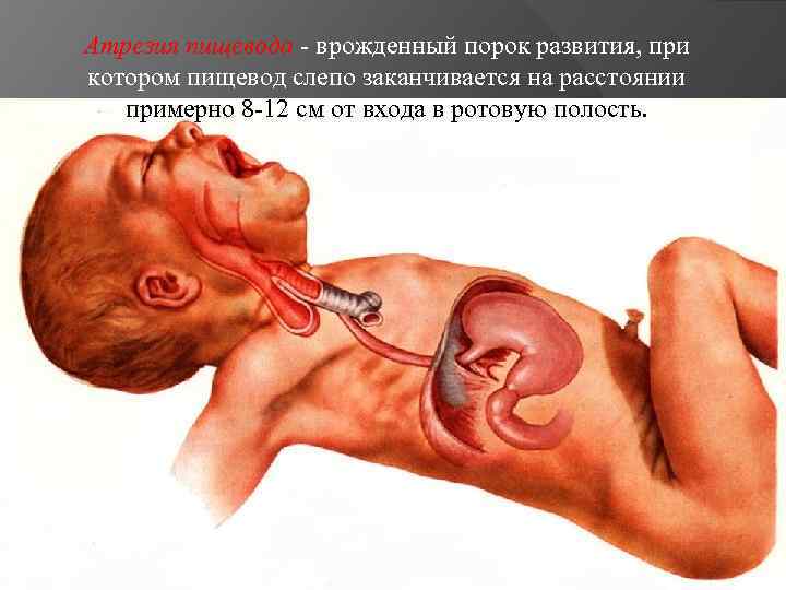 Атрезия пищевода - врожденный порок развития, при котором пищевод слепо заканчивается на расстоянии примерно