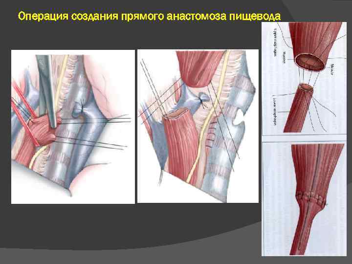 Операция разработка. Прямой анастомоз пищевода. Отсроченный анастомоз пищевода. Анастомоз межбронхиальный.