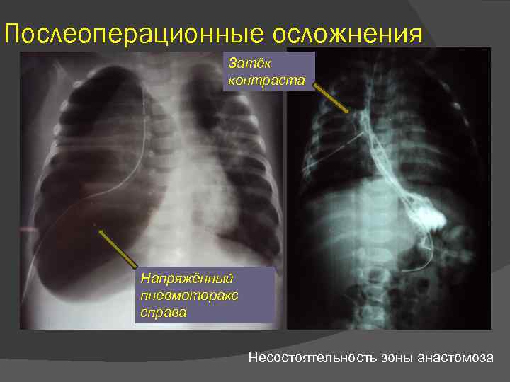 Послеоперационные осложнения Затёк контраста Напряжённый пневмоторакс справа Несостоятельность зоны анастомоза 