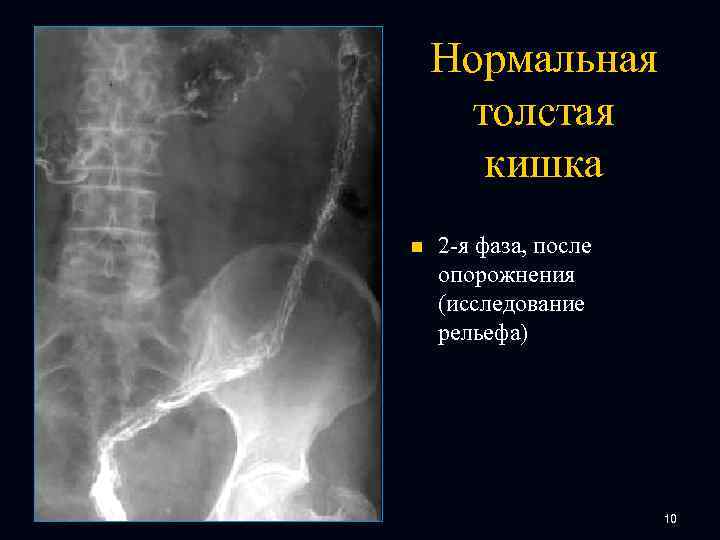 Нормальная толстая кишка n 2 -я фаза, после опорожнения (исследование рельефа) 10 