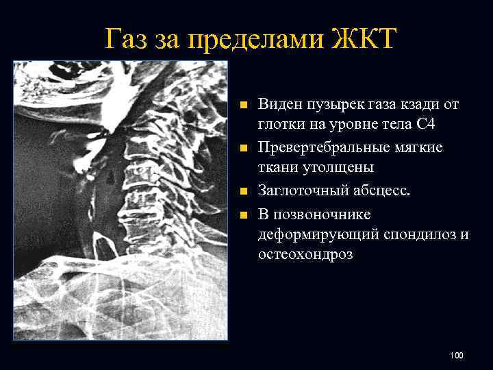 Газ за пределами ЖКТ n n Виден пузырек газа кзади от глотки на уровне