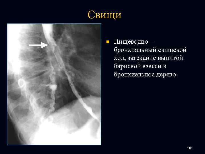 Свищи n Пищеводно – бронхиальный свищевой ход, затекание выпитой бариевой взвеси в бронхиальное дерево