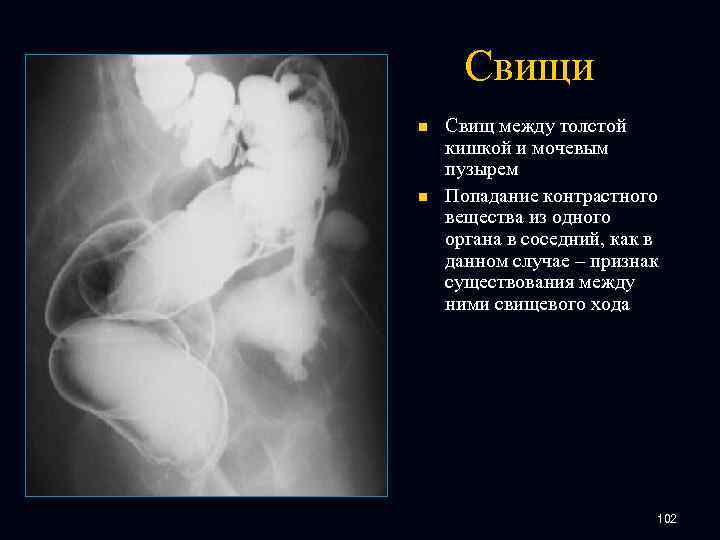 Свищи n n Свищ между толстой кишкой и мочевым пузырем Попадание контрастного вещества из