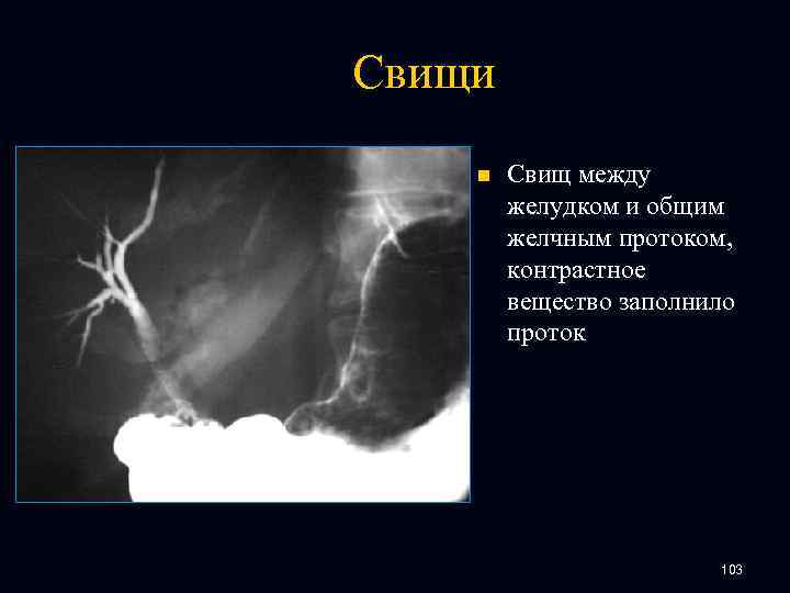 Свищи n Свищ между желудком и общим желчным протоком, контрастное вещество заполнило проток 103
