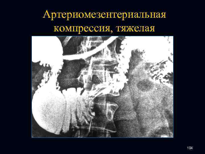 Артериомезентериальная компрессия, тяжелая 104 