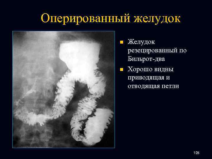 Оперированный желудок n n Желудок резецированный по Бильрот-два Хорошо видны приводящая и отводящая петли