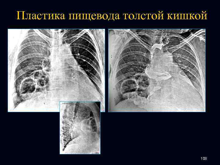 Пластика пищевода толстой кишкой 108 