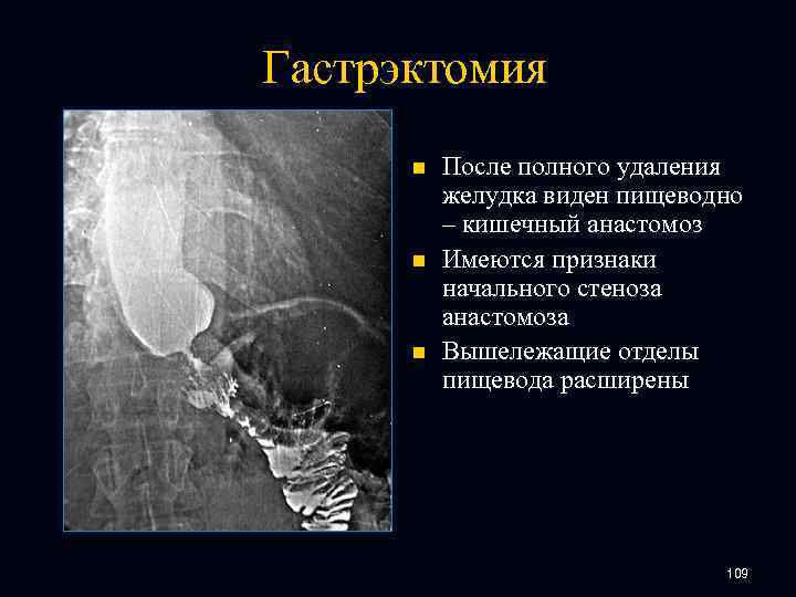 Гастрэктомия n n n После полного удаления желудка виден пищеводно – кишечный анастомоз Имеются