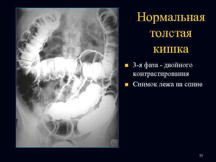 Нормальная толстая кишка n n 3 -я фаза - двойного контрастирования Снимок лежа на