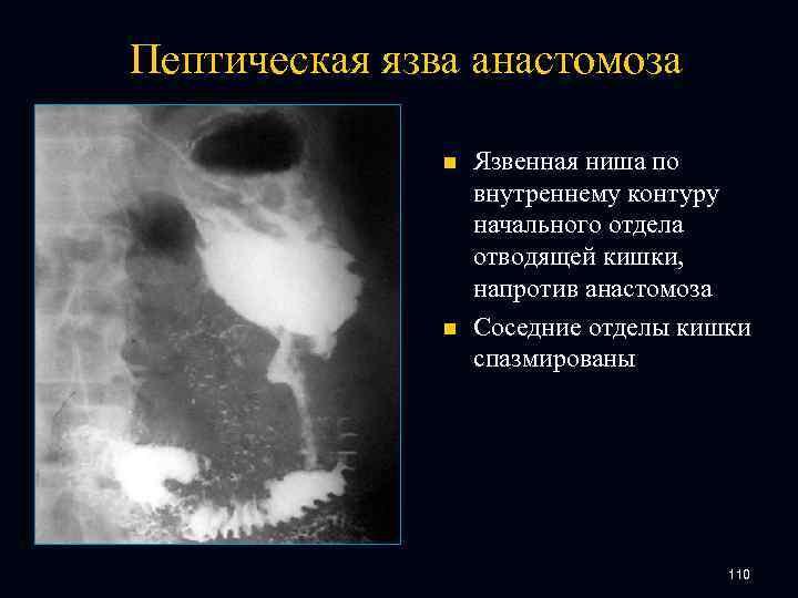 Пептическая язва анастомоза n n Язвенная ниша по внутреннему контуру начального отдела отводящей кишки,