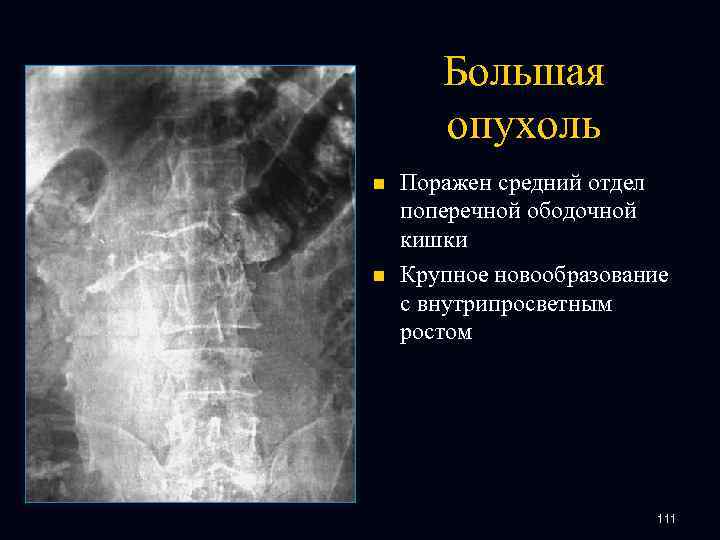 Большая опухоль n n Поражен средний отдел поперечной ободочной кишки Крупное новообразование с внутрипросветным