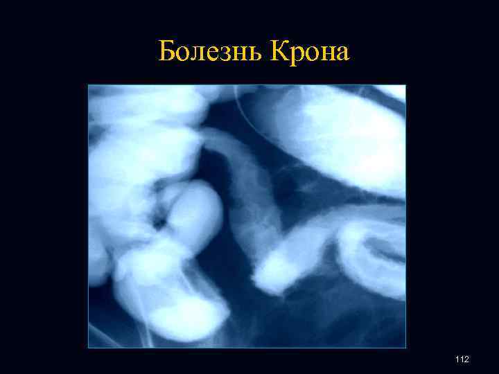 Болезнь Крона 112 