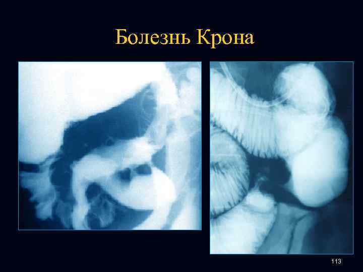 Болезнь Крона 113 