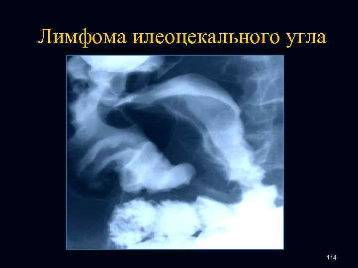 Лимфома илеоцекального угла 114 
