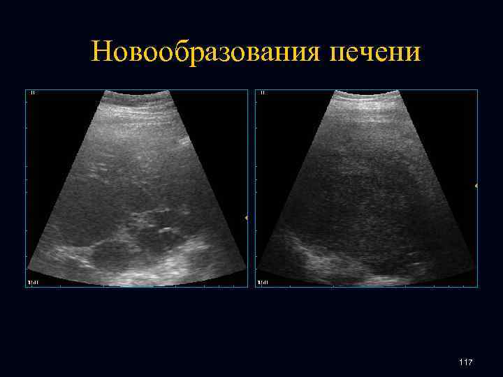 Новообразования печени 117 