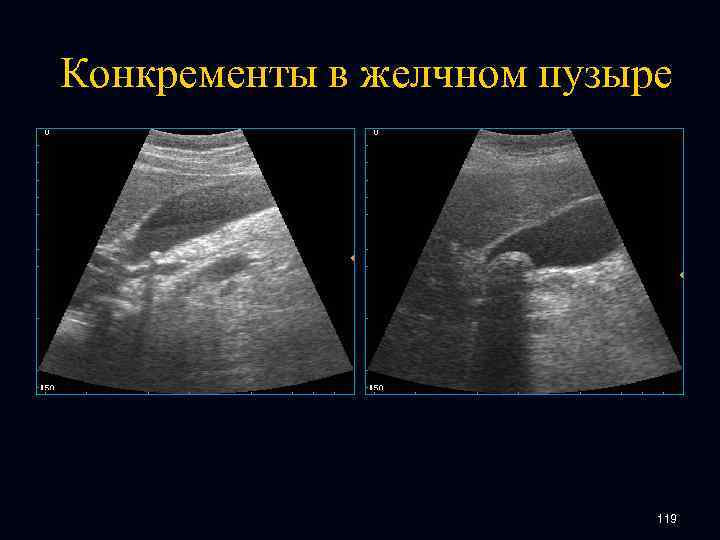 Конкременты в желчном пузыре 119 