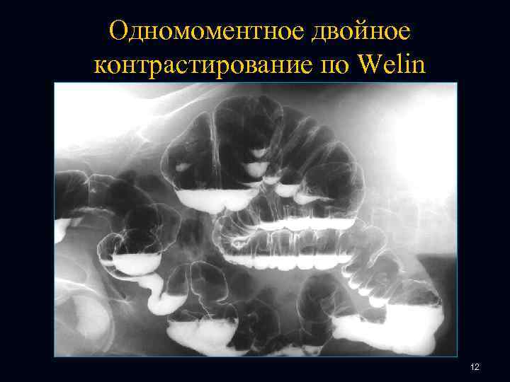 Одномоментное двойное контрастирование по Welin 12 
