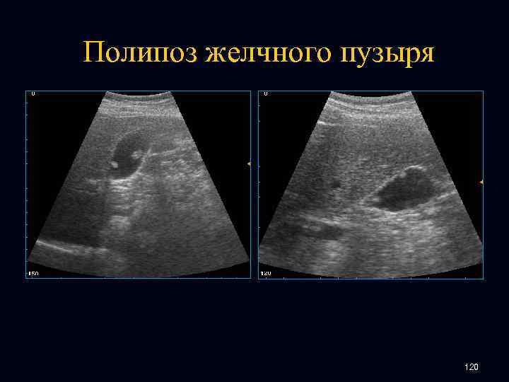 Полипоз желчного пузыря 120 