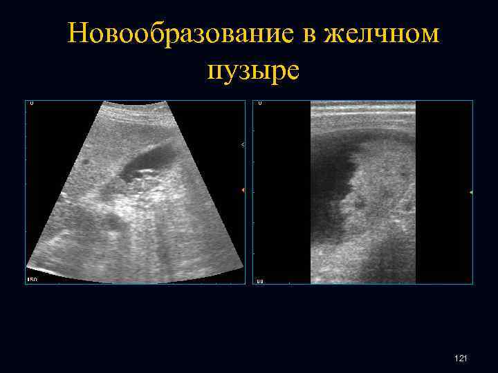 Новообразование в желчном пузыре 121 