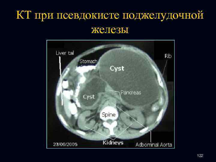 КТ при псевдокисте поджелудочной железы 122 