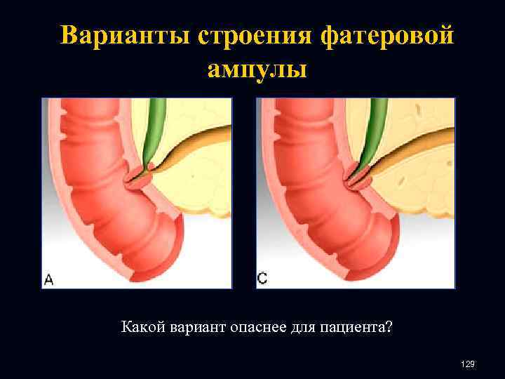 Варианты строения фатеровой ампулы Какой вариант опаснее для пациента? 129 