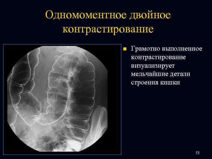 Одномоментное двойное контрастирование n Грамотно выполненное контрастирование визуализирует мельчайшие детали строения кишки 13 