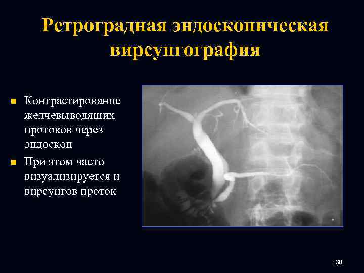 Ретроградная эндоскопическая вирсунгография n n Контрастирование желчевыводящих протоков через эндоскоп При этом часто визуализируется