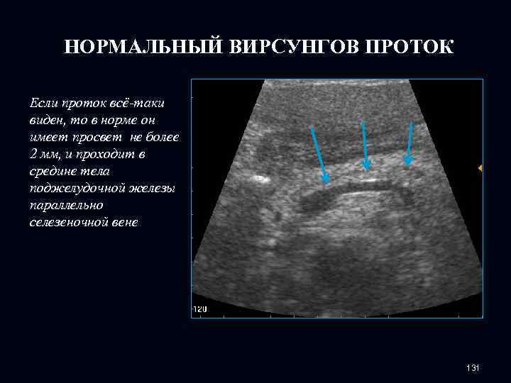НОРМАЛЬНЫЙ ВИРСУНГОВ ПРОТОК Если проток всё-таки виден, то в норме он имеет просвет не