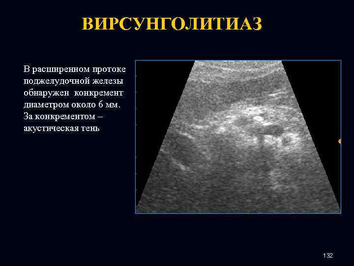 ВИРСУНГОЛИТИАЗ В расширенном протоке поджелудочной железы обнаружен конкремент диаметром около 6 мм. За конкрементом