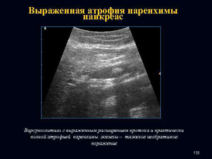 Выраженная атрофия паренхимы панкреас Вирсунголитиаз с выраженным расширением протока и практически полной атрофией паренхимы