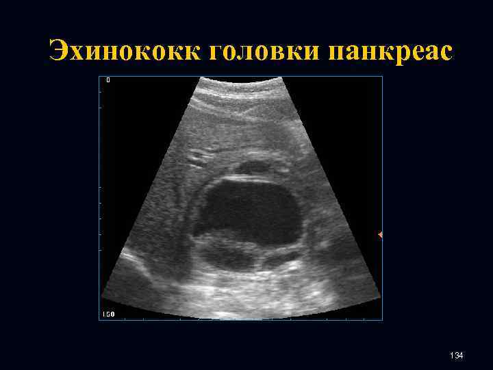 Эхинококк головки панкреас 134 