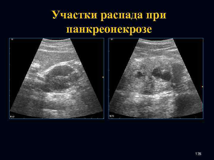 Участки распада при панкреонекрозе 135 
