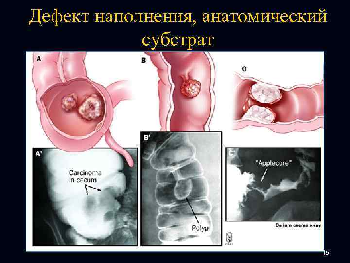 Дефект наполнения, анатомический субстрат 15 