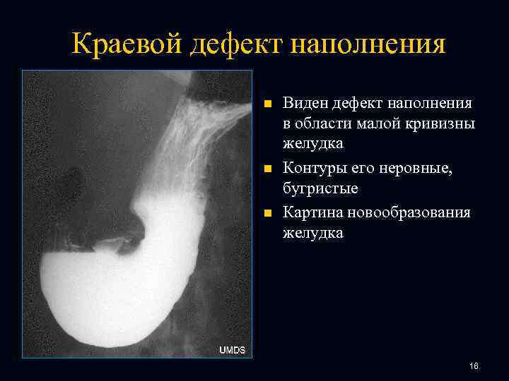 Краевой дефект наполнения n n n Виден дефект наполнения в области малой кривизны желудка