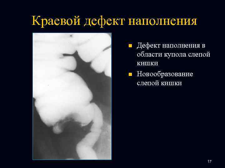 Краевой дефект наполнения n n Дефект наполнения в области купола слепой кишки Новообразование слепой