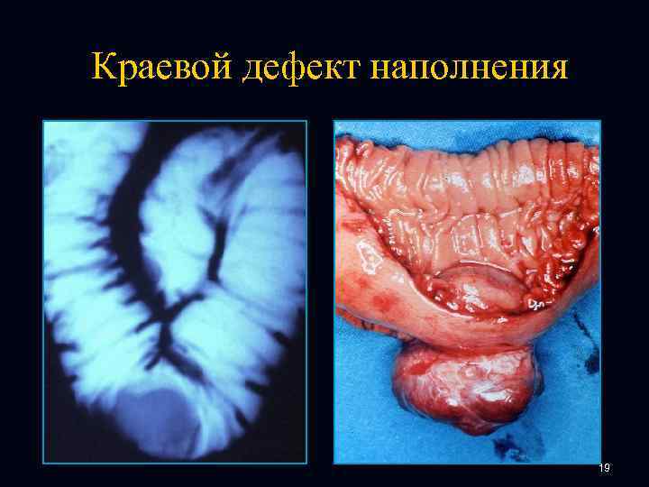 Краевой дефект наполнения 19 