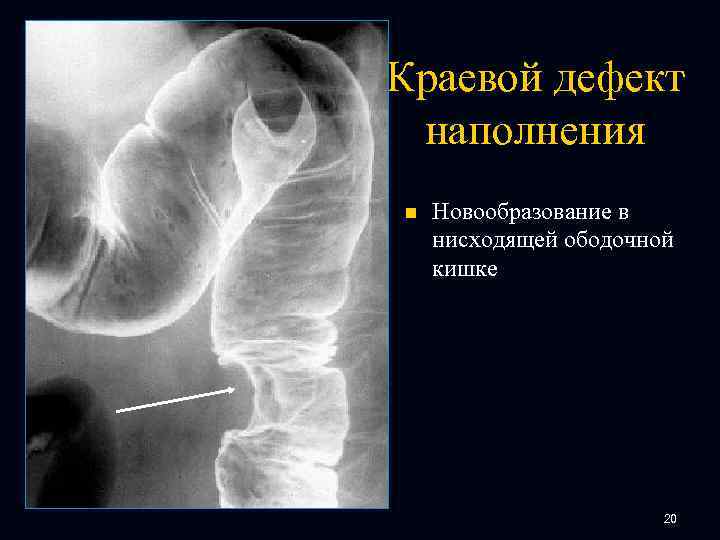 Краевой дефект наполнения n Новообразование в нисходящей ободочной кишке 20 