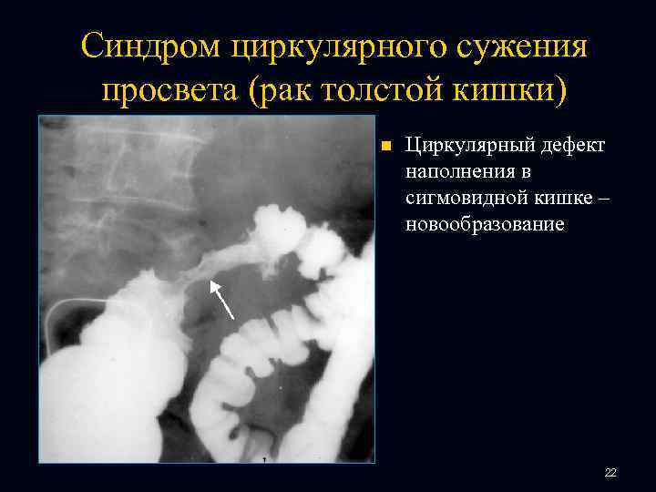 Синдром циркулярного сужения просвета (рак толстой кишки) n Циркулярный дефект наполнения в сигмовидной кишке