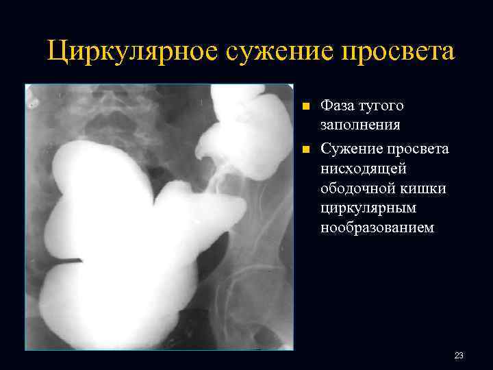 Циркулярное сужение просвета n n Фаза тугого заполнения Сужение просвета нисходящей ободочной кишки циркулярным