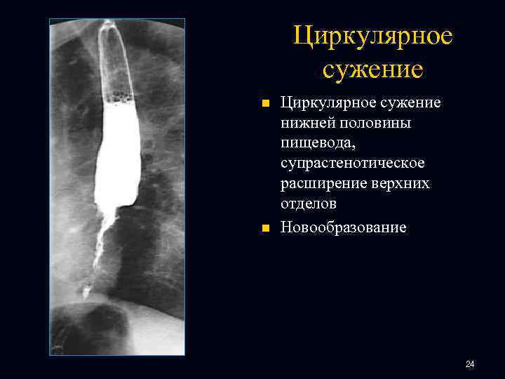 Циркулярное сужение n n Циркулярное сужение нижней половины пищевода, супрастенотическое расширение верхних отделов Новообразование